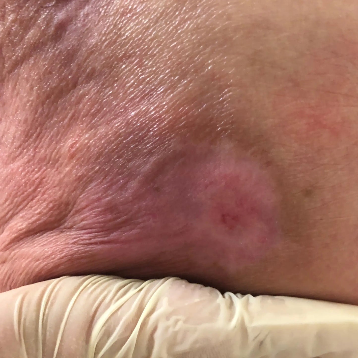 Cuidado hidratante de la piel de una persona con escaras tras la higiene corporal con Body Milk S’Nonas en Gran Canaria